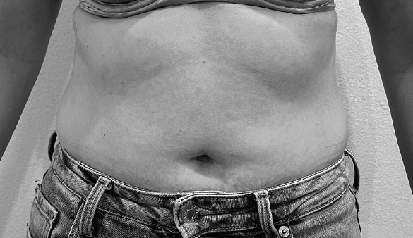 Before BAUD Liftwear — case 3, Postpartum, age 38